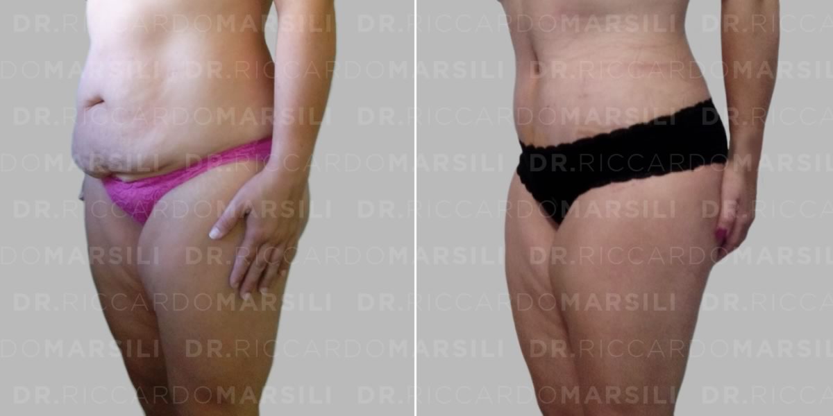 Abdominoplastie Paris, chirurgien spécialiste, prix et tarif